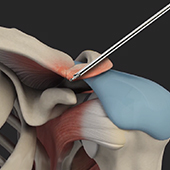 AC Joint Stabilisation