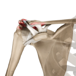 Arthritis of the Acromioclavicular (Ac) Joint 