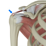 Calcific Tendinopathy of the Shoulder