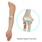 Radial Head Fractures of the Elbow