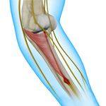 Radial Tunnel Syndrome