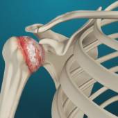 Arthritis of the Shoulder (Glenohumeral) Joint