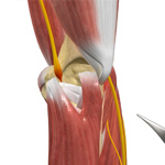 Ulnar Nerve Transposition