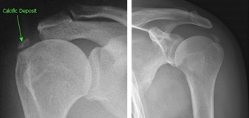 Calcific Tendinopathy of the Shoulder