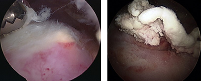 Calcific Tendinopathy of the Shoulder