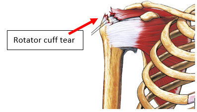 Rotator Cuff Repair Auckland, NZ