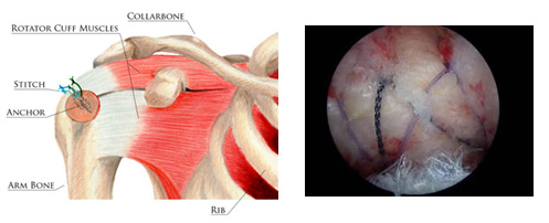 Rotator Cuff Repair