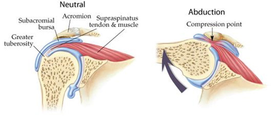 Shoulder Impingement