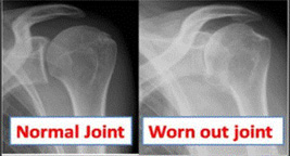 Shoulder Joint Replacement