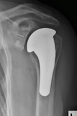 Shoulder Joint Replacement