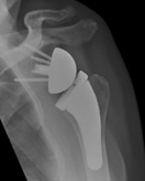 Shoulder Joint Replacement