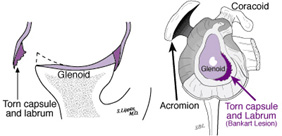 Shoulder Stabilization