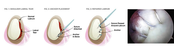 Shoulder Stabilization